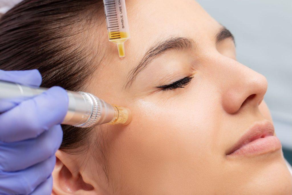 The Benefits of Micro Needling for Rejuvenated Skin